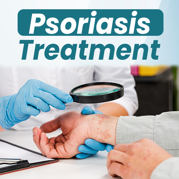  Achieving a Permanent Solution for Psoriasis Naturally: Effective Treatments for Facial and Scalp Psoriasis