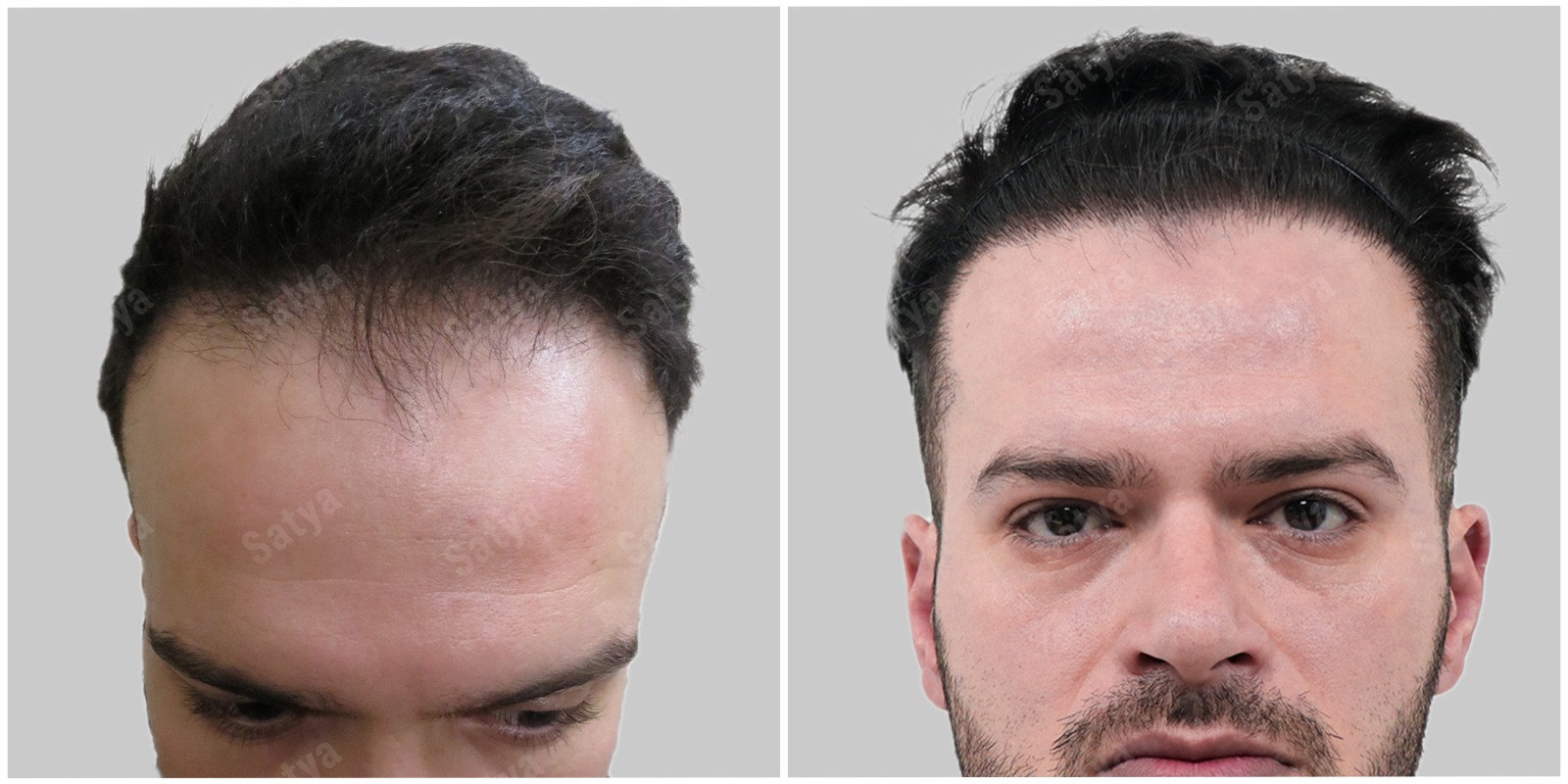  Trusted Clinic for Hair Transplant in Gurgaon - Satya Hair Solutions